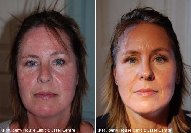 Before and after LED treatment for rosacea and skin rejuvenation